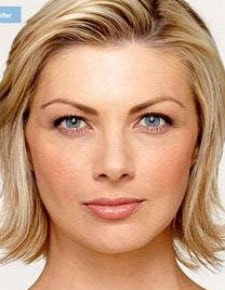 Botox after photo, front view (case 6460)