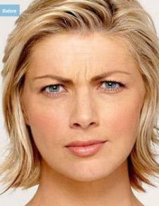 Botox before photo, front view (case 6460)