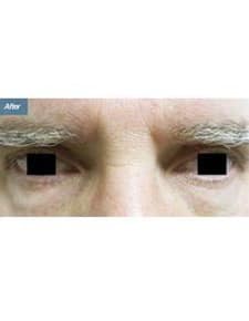 Eyelid Surgery after photo, close-up view (case 6462)