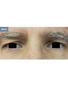 Eyelid Surgery before photo, close-up view (case 6462)