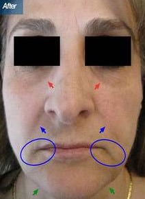 Fat Transfer and Suction after photo, front view (case 6463)