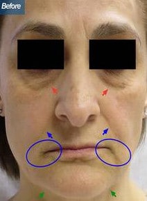 Fat Transfer and Suction before photo, front view (case 6463)