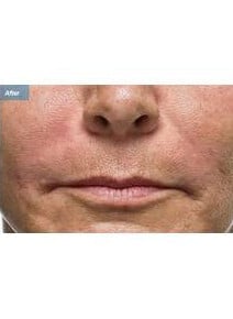 Fillers after photo, close-up view (case 6464)