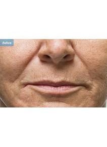 Fillers before photo, close-up view (case 6464)