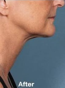 Kybella after photo, side view (case 6465)