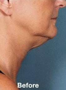 Kybella before photo, side view (case 6465)