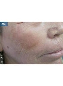 Laser Resurfacing after photo, close-up view (case 6466)