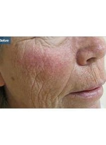 Laser Resurfacing before photo, close-up view (case 6466)