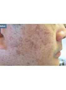 Laser before photo, close-up view (case 6467)