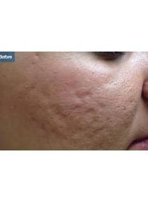 Microneedling before photo, close-up view (case 6468)