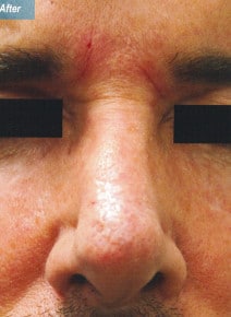 Fillers after photo, front view (case 9015)