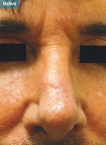 Fillers before photo, front view (case 9015)