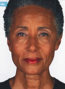 Botox Forehead after photo, front view (case 9023)