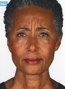 Botox Forehead before photo, front view (case 9023)
