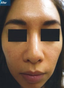 Botox Masseter Muscles after photo, front view (case 9024)