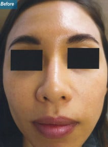 Botox Masseter Muscles before photo, front view (case 9024)