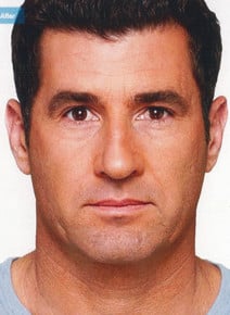 Botox Forehead after photo, front view (case 9025)