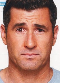 Botox Forehead before photo, front view (case 9025)