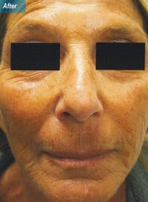Radiesse Cheeks after photo, front view (case 9035)