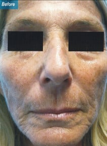 Radiesse Cheeks before photo, front view (case 9035)