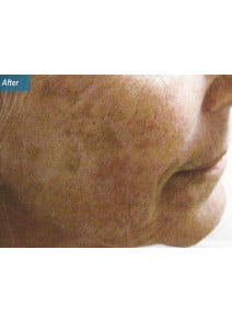 Radiesse Cheeks after photo, right view (case 9035)