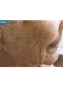 Radiesse Cheeks before photo, right view (case 9035)