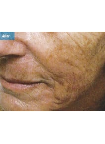 Radiesse Cheeks after photo, oblique left view (case 9035)
