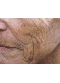 Radiesse Cheeks before photo, oblique left view (case 9035)