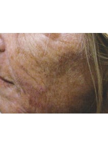 Radiesse Cheeks after photo, left view (case 9035)