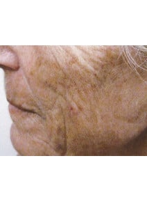 Radiesse Cheeks before photo, left view (case 9035)