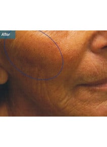 Radiesse Cheeks after photo, oblique right view (case 9045)