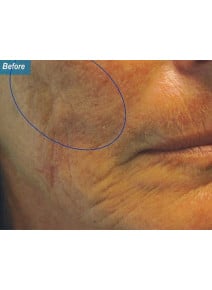 Radiesse Cheeks before photo, oblique right view (case 9045)