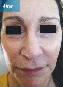 Chemical Peels after photo, front view (case 9049)