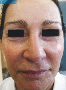 Chemical Peels before photo, front view (case 9049)