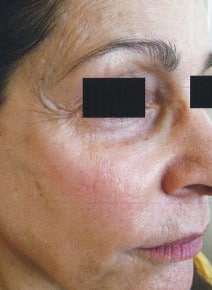 Chemical Peels after photo, oblique right view (case 9049)