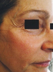 Chemical Peels before photo, oblique right view (case 9049)