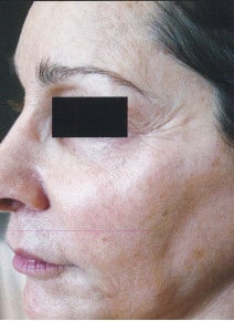 Chemical Peels after photo, oblique left view (case 9049)