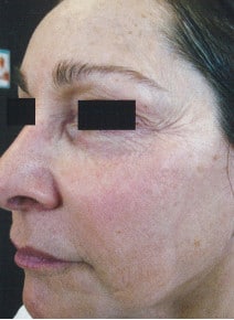 Chemical Peels before photo, oblique left view (case 9049)