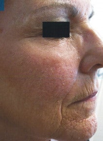 CO2 Laser Resurfacing after photo, right view (case 9059)