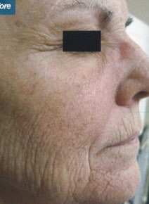 CO2 Laser Resurfacing before photo, right view (case 9059)