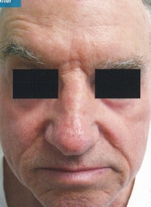 CO2 Laser Resurfacing after photo, front view (case 9062)