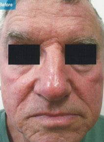 CO2 Laser Resurfacing before photo, front view (case 9062)