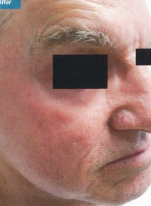 CO2 Laser Resurfacing after photo, oblique right view (case 9062)