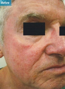 CO2 Laser Resurfacing before photo, oblique right view (case 9062)