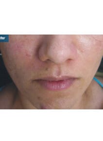 CO2 Laser Resurfacing after photo, front view (case 9066)
