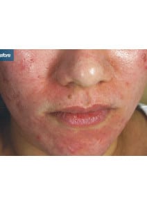CO2 Laser Resurfacing before photo, front view (case 9066)