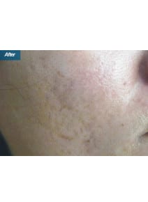CO2 Laser Resurfacing after photo, oblique right view (case 9066)