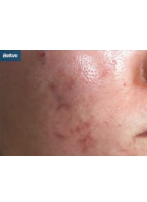 CO2 Laser Resurfacing before photo, oblique right view (case 9066)