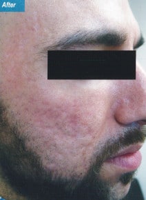 CO2 Laser Resurfacing after photo, oblique right view (case 9070)
