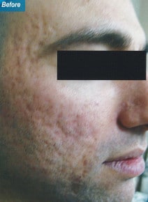 CO2 Laser Resurfacing before photo, oblique right view (case 9070)